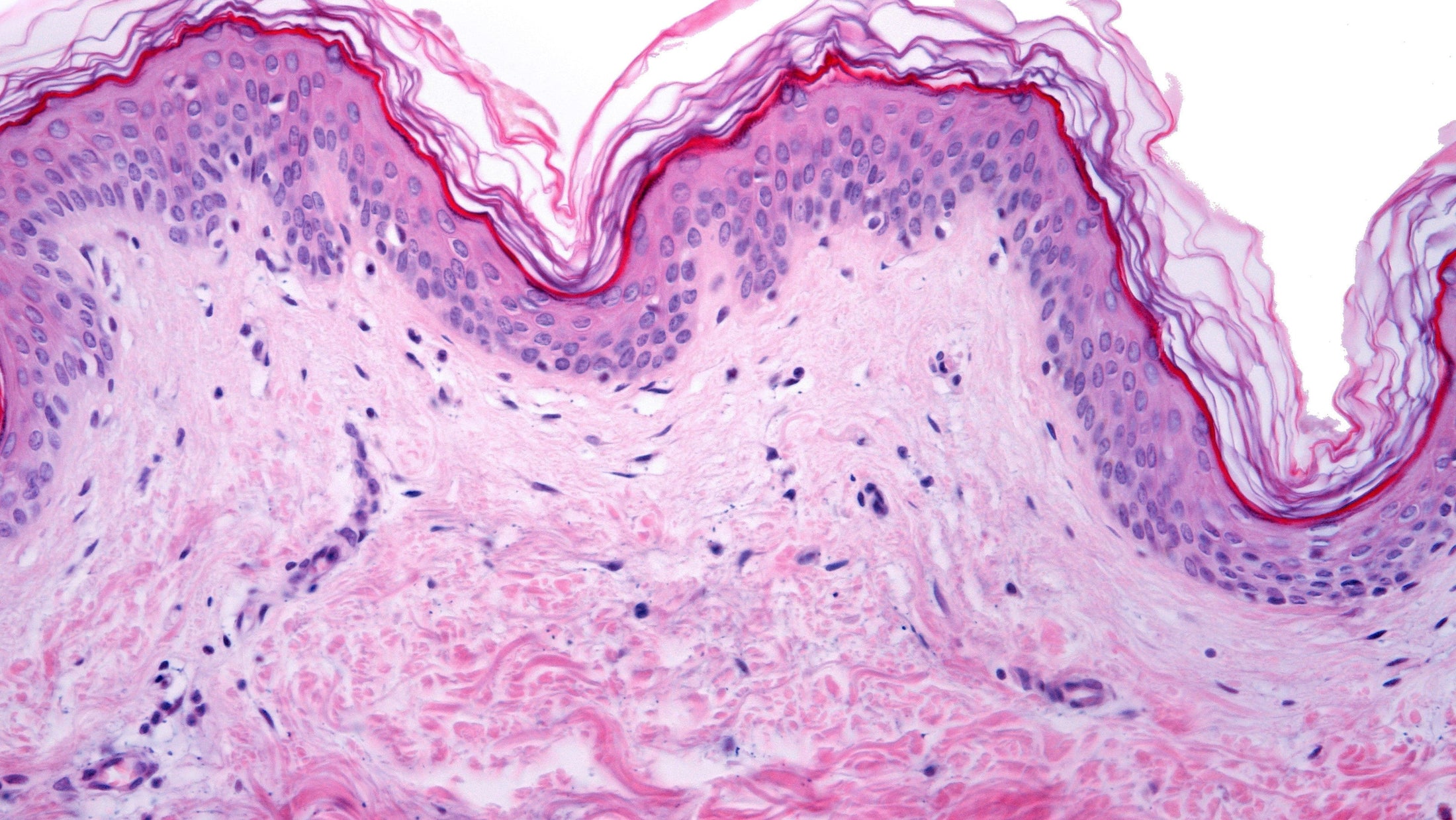 Senolytic Trial in Skin, With Broader Implications