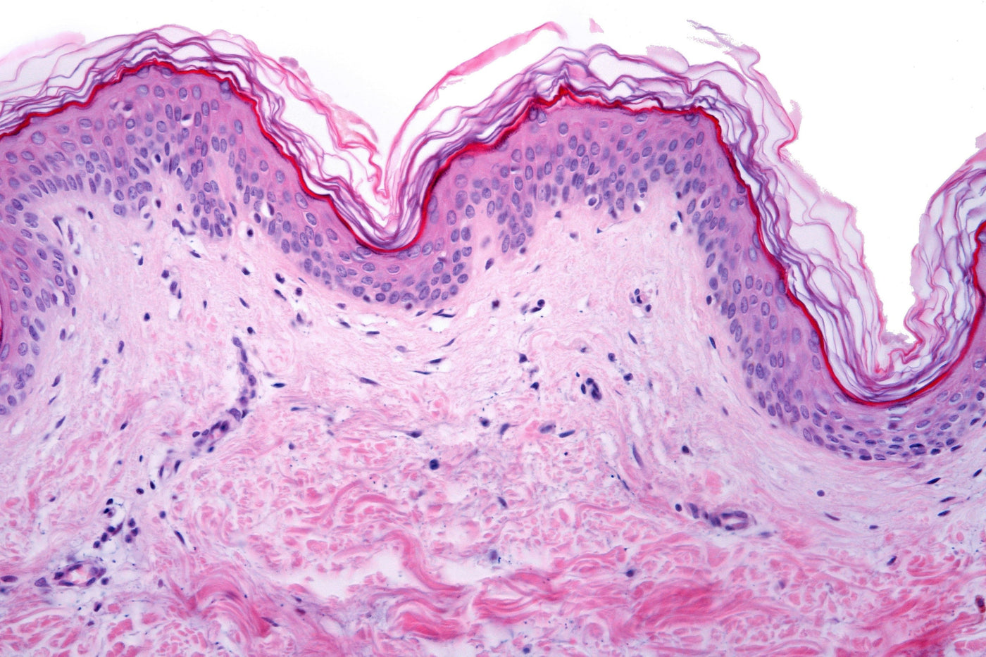 Senolytic Trial in Skin, With Broader Implications